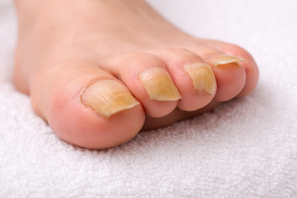 oczyszczanie zmienionej chorobowo płytki paznokcia grzybica Szczytniki