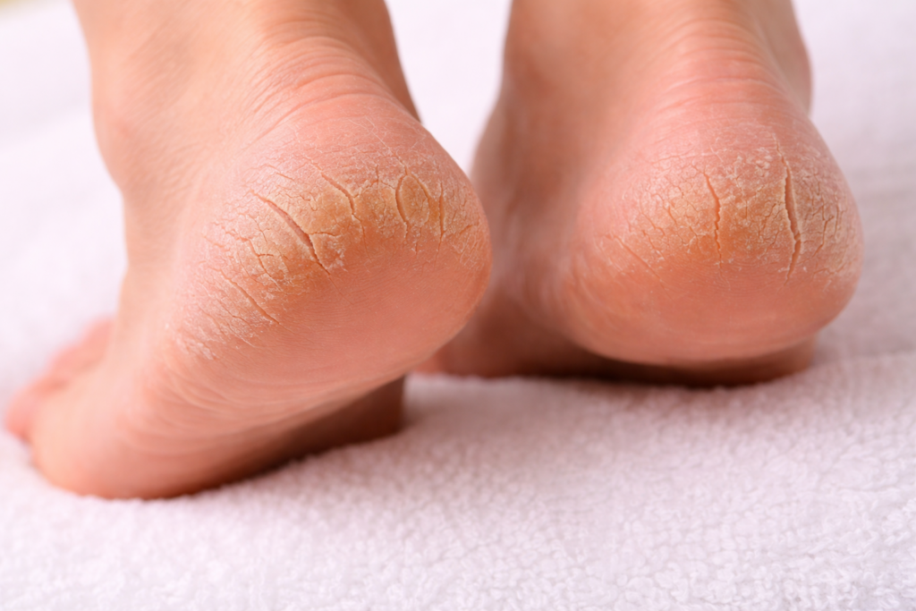 terapia pękających pięt i rozpadlin podologia mobilna Borówiec